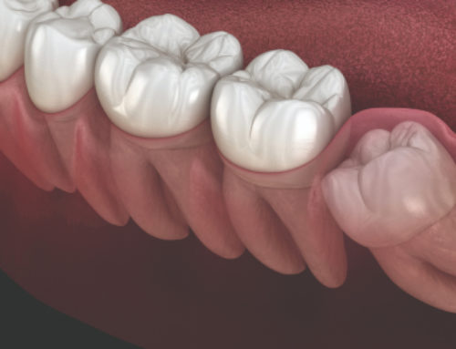 Trattamenti denti inclusi