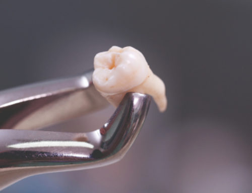 Chirurgia estrattiva