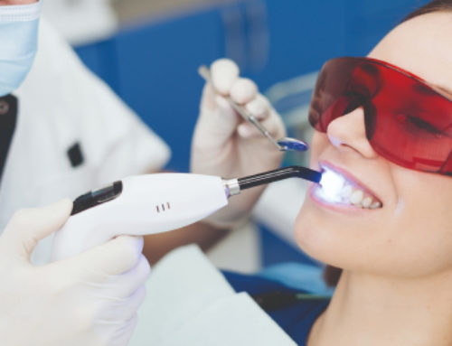 Sbiancamento professionale/domiciliare