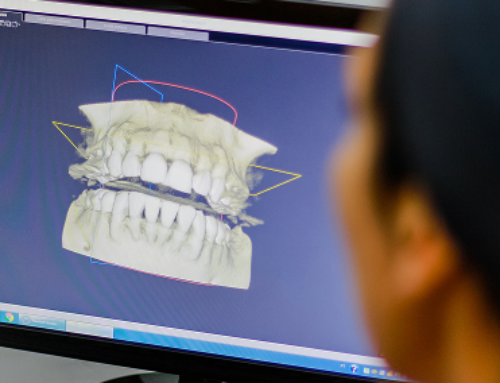 Implantologia computer guidata