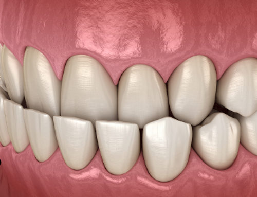 Malocclusioni dentali